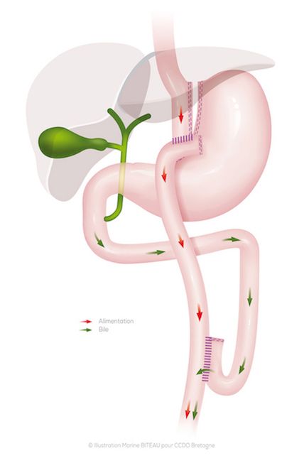 Schéma d'un bypass gastrique avec anse en Y et anse en oméga au CCDO Bretagne