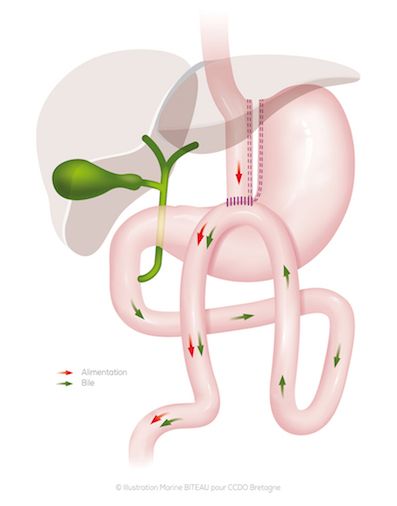 Schéma d'un Bypass gastrique avec anse en oméga - ccdo Bretagne