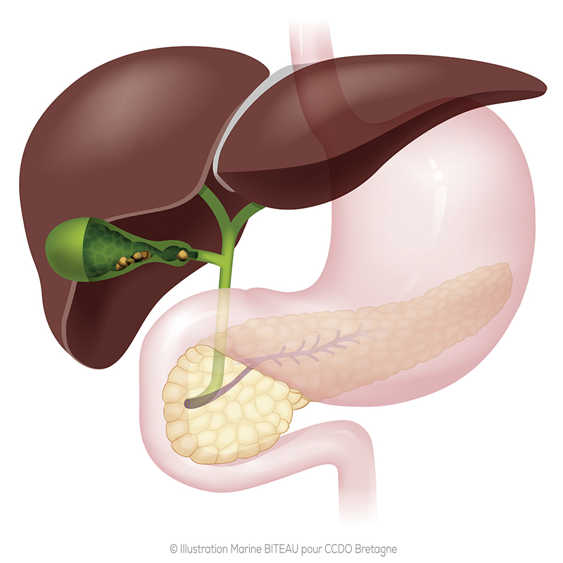 Schéma et Radio de calculs de la vésicule biliaire CCDO Bretagne 22/09/2023