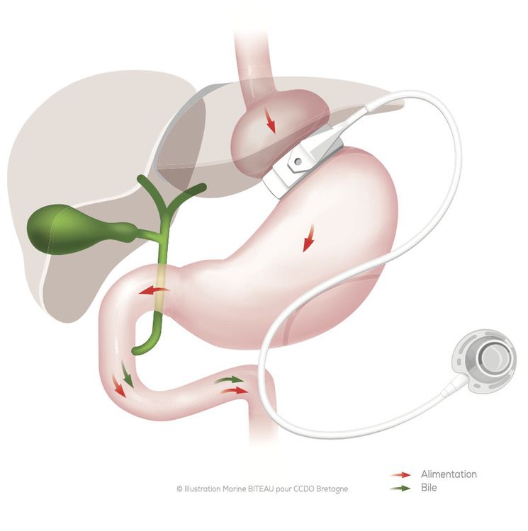 Illustration d'un anneau gastrique posé