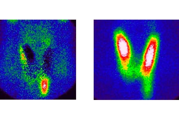 Images de scintigraphie parathyroïdienne