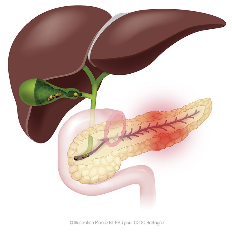 Pancréatite aigue d'origine lithiasique CCDO Bretagne 25/09/2023